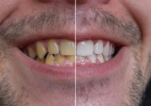 Comment enlever les taches de tabac sur les dents